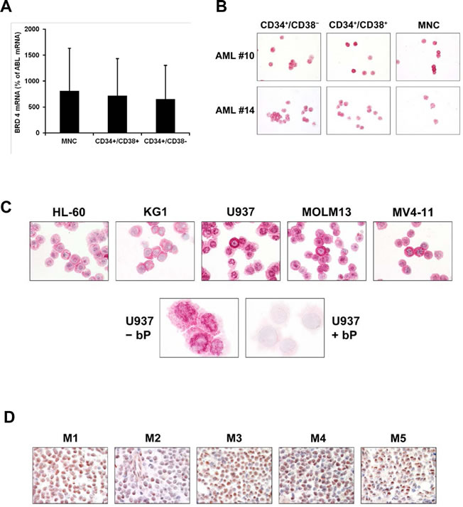 Expression of BRD4 in leukemic cells in acute myeloid leukemia (AML).