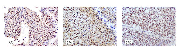 Immunohistochemistry of AR, ER&#x3b1;, and ER&#x3b2; in urothelial tumors.