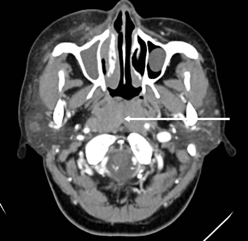 Contrast brain computed tomography shows diffuse swelling of the posterior wall of the pharynx with mild enhancement.