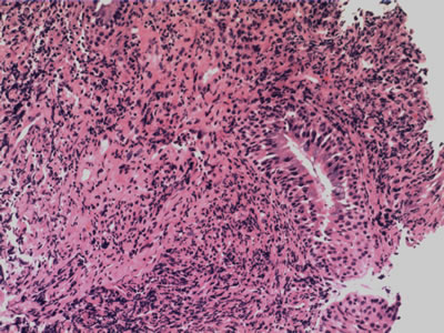 Pathology of the thickened nasopharyngeal mucosa