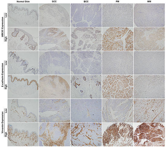 UBE3C, E-cadherin and vimentin expression in various skin cancer tissues and normal skin