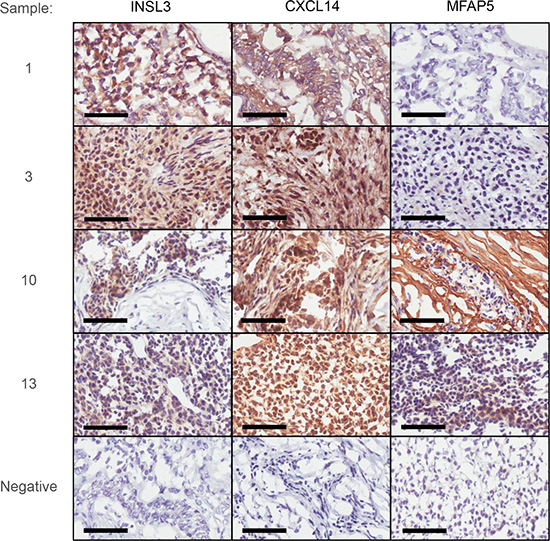 Immunohistochemical examination of INSL3, CXCL14 and MFAP5 in two stage 1 (1 and 3) and two stage 3 aGCT (10 and 13).