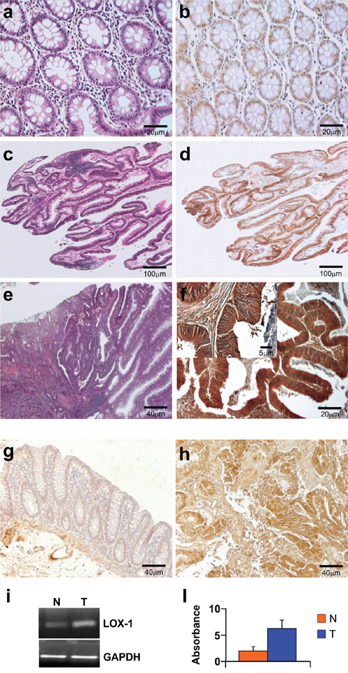 Immunohistochemistry and RNA expression of LOX-1 in colorectal cancer patients.