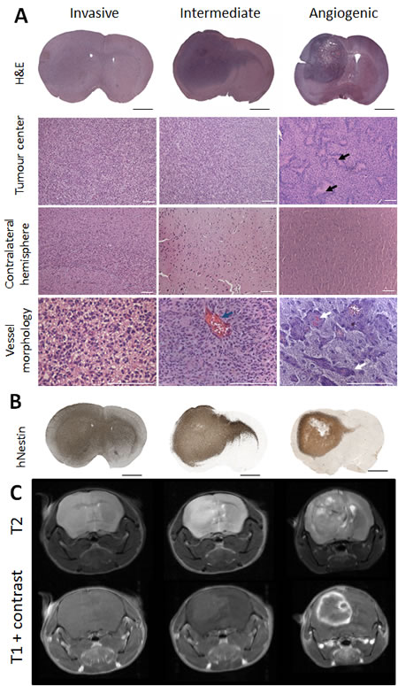 Phenotypic intertumoural heterogeneity in patient-derived glioblastoma xenografts.