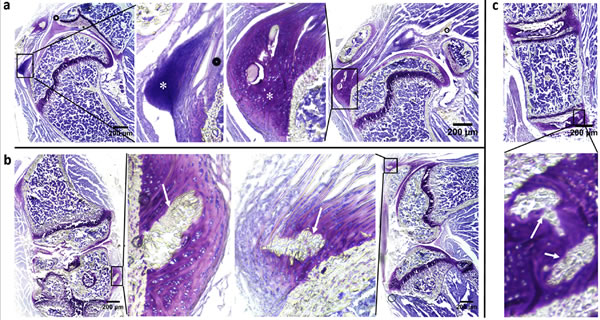 Aberrant fibrocartilage and presence of osteophytes preceding mineralization in