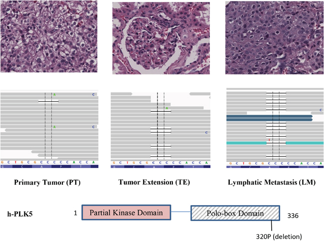 Increasing frequency of a Plk5 mutation in lymphatic metastasis (LM).