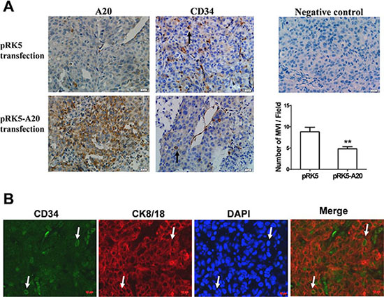 Overexpression of A20 inhibited MVI in HCC xenograft.