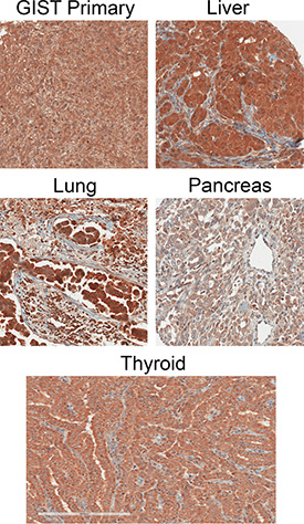 Example IHC images of cancer specimens using the CCK2R specific antibody 6C10G11.