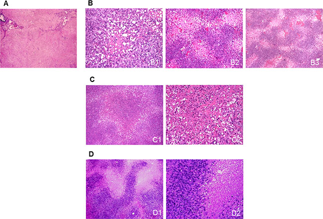 Sunitinib-induced morphological changes in surgical samples.