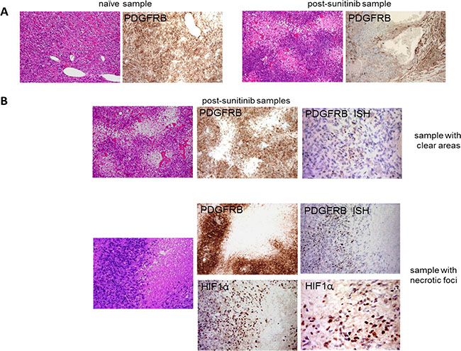 Sunitinib-induced changes in the morphology of tumour cells and their PDGFRB and HIF1&#x03B1; expression.