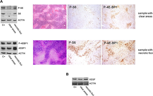 Comparison of mTOR effector phosphorylation and VEGF expression in post-sunitinib samples with clear areas or necrotic foci.