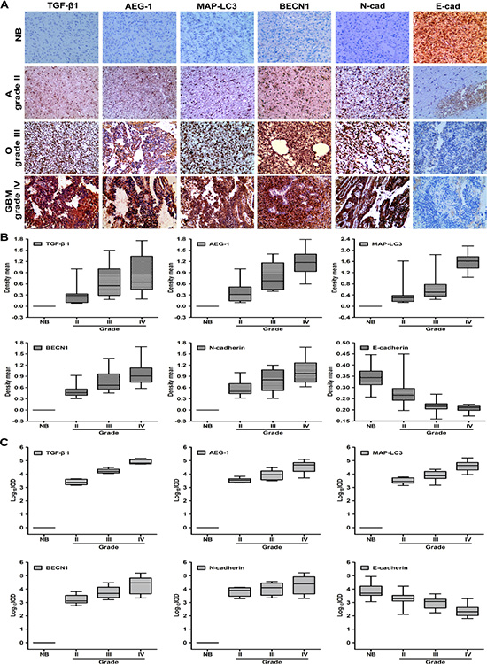 The expression of AEG-1, autophagy hallmarks and EMT is high in diverse malignant glioma tumors.