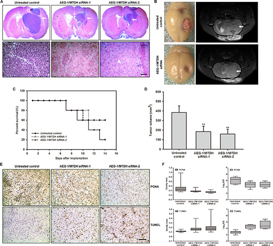 Administration of siRNA-AEG-1/MTDH reduces tumor progression in the rat glioma model.