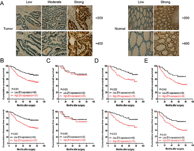 Expression and clinical significance of ZFX in colorectal cancer (CRC).
