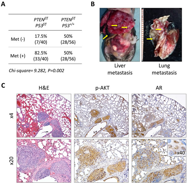 Development of metastatic prostate cancer in