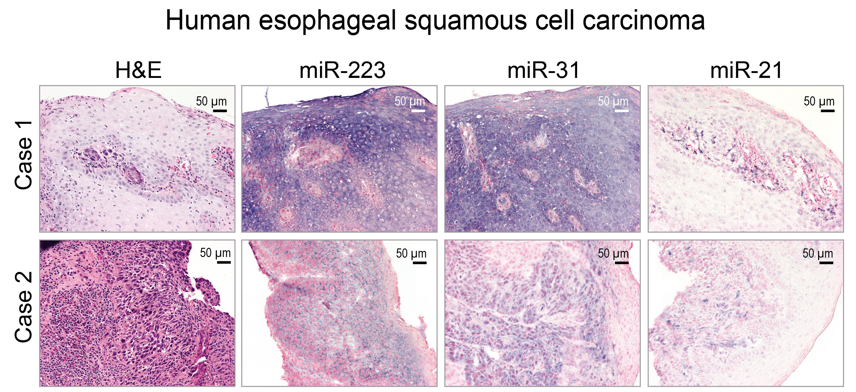 Localization of miR-223, miR-31, and miR-21 in human esophageal squamous cell carcinoma (ESCC) tissue by in situ hybridization (ISH).