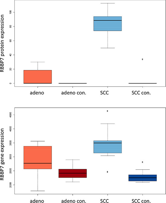 Figure 6C: Expression of RBB7 in adenocarcinoma, SCC and respective controls in mRNA and proteins are presented.