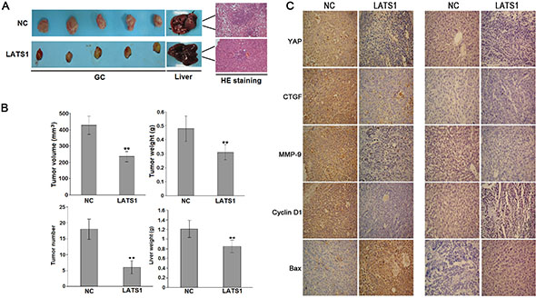 LATS1 suppressed the tumorigenicity and liver metastasis of SGC-7901 cells in vivo.