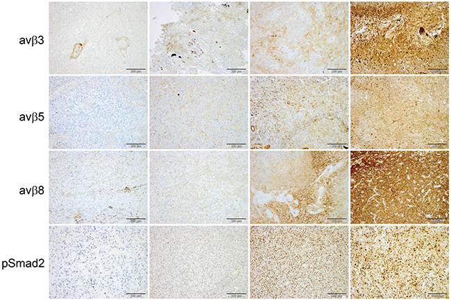 Immunohistochemical assessment of integrins and pSmad2 in glioblastoma.