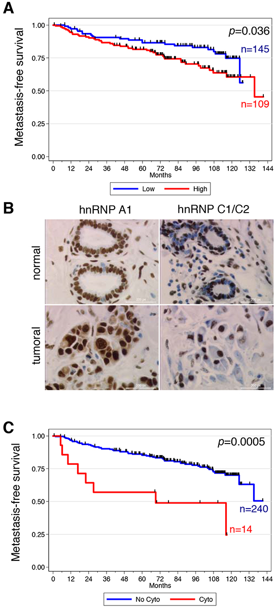 High expression and cytoplasmic localization of hnRNP A1 are associated with metastatic relapse in patients with invasive breast cancer.