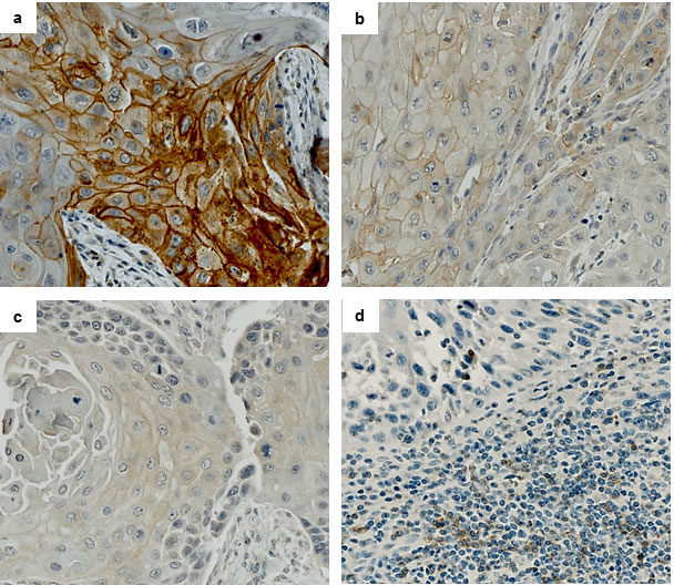 Squamous cell carcinoma of the head and neck, showing membraneous PD-L1 expression in tumor cells with