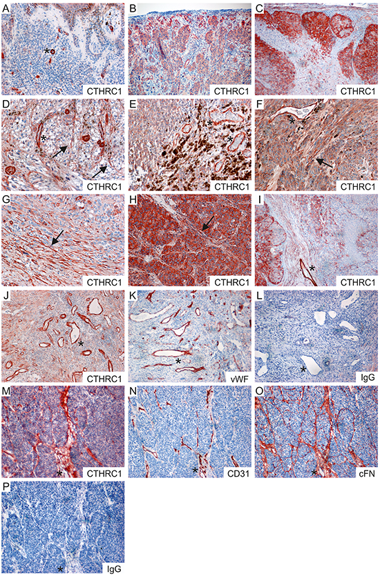 Immunohistochemical staining of CTHRC1, vWF, CD31, and cFN in primary melanomas and melanoma metastases.
