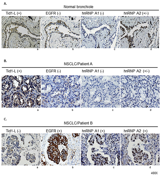 Immunohistochemical (IHC) staining of Tid1-L, hnRNP A1, hnRNP A2, and EGFR in NSCLC tissues.