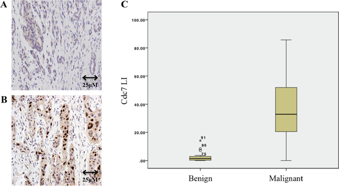 Immunohistochemistry of benign A. and malignant B. pancreatic tissue showing Cdc7 staining.