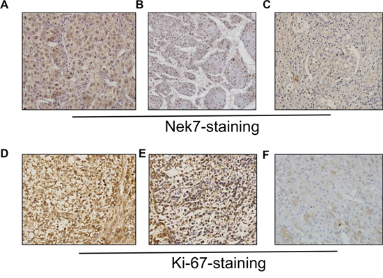 Immunohistochemistry of Nek7 and Ki-67 on HCC specimens.