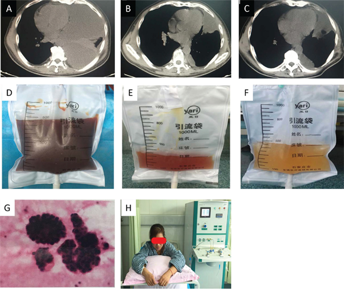 Recurrent pleural effusion after surgical resection of lung adenocarcinoma.