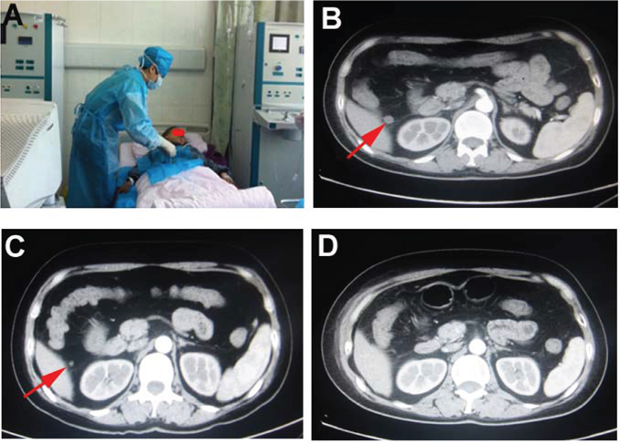 Lymph node metastasis of ovarian cancer.