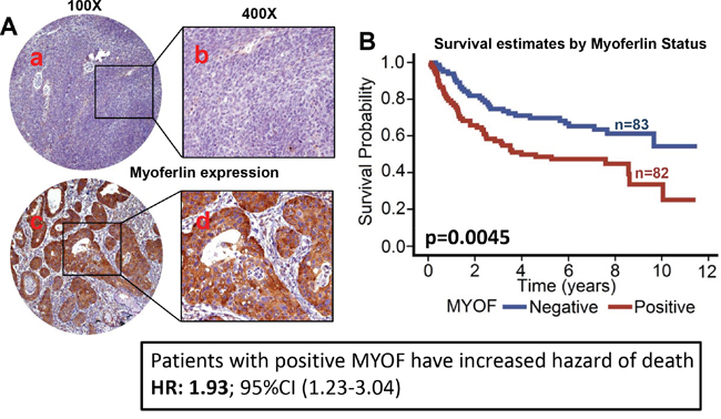 Myoferlin expression is associated with poor overall survival in OPSCC.