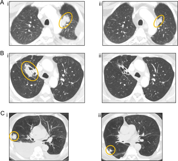 Computed tomography (CT) images of the three patients with the greatest tumor reduction.