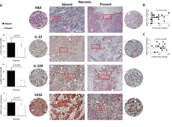 IL-33, IL-33R and VEGF expression in human breast carcinoma with present or absent tumor necrosis.