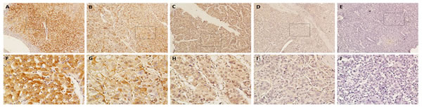 Immunohistochemical analysis of BRD7 protein expression in primary HCC surgical specimens.