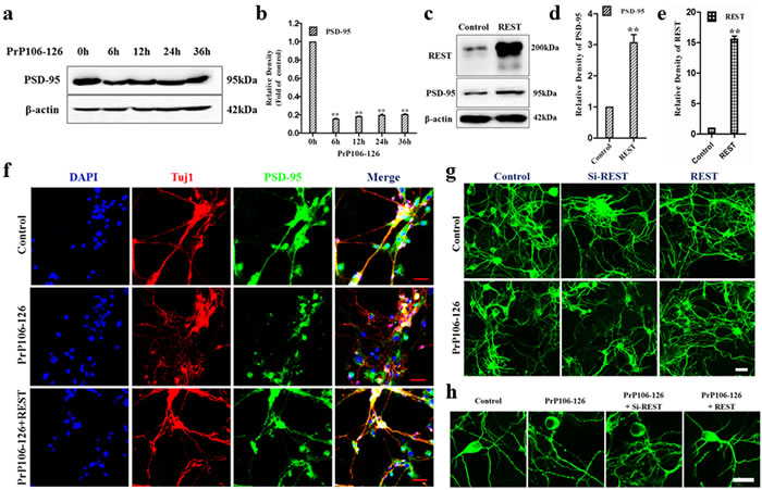 REST protects PCCN from PrP106-126 induced synaptic damage and neurofibrillary degeneration.