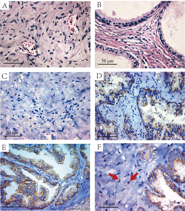 The H&amp;E and immunohistochemistry staining of HIF-l&#x3b1; in the intra-acinar and peri-acinar of BPH tissues.