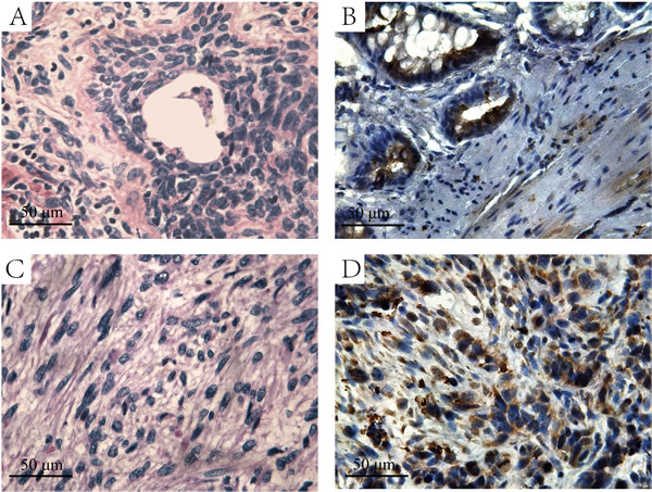 The H&amp;E and immunohistochemistry staining of HIF-l&#x3b1; in prostate cancer and sarcoma tissues.