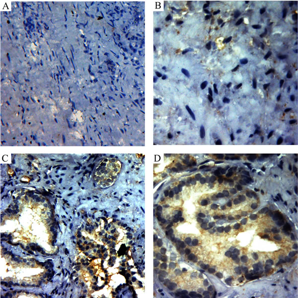 Immunohistochemistry staining of VEGF in the intra-acinar and peri-acinar of BPH tissues.