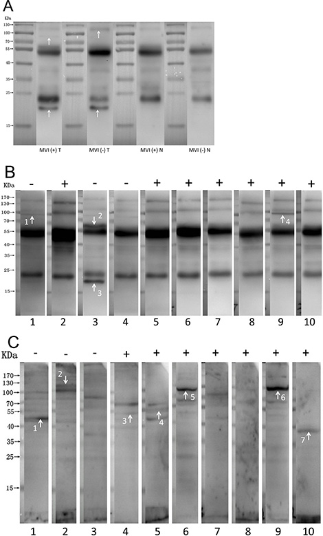 Antigen-antibody reactions between HCC lysates and serum.
