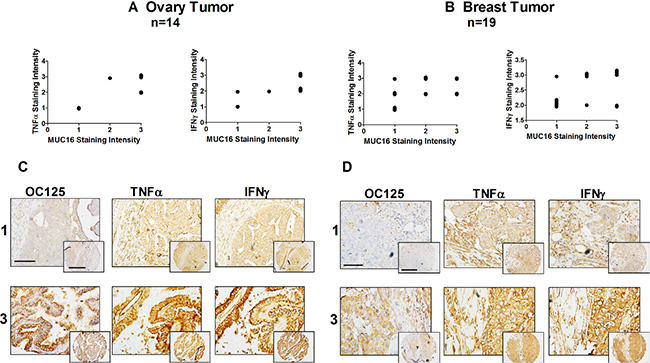 MUC16, TNF&#x03B1;, and IFN&#x03B3; are co-expressed in malignant ovarian and uterine neoplasms.