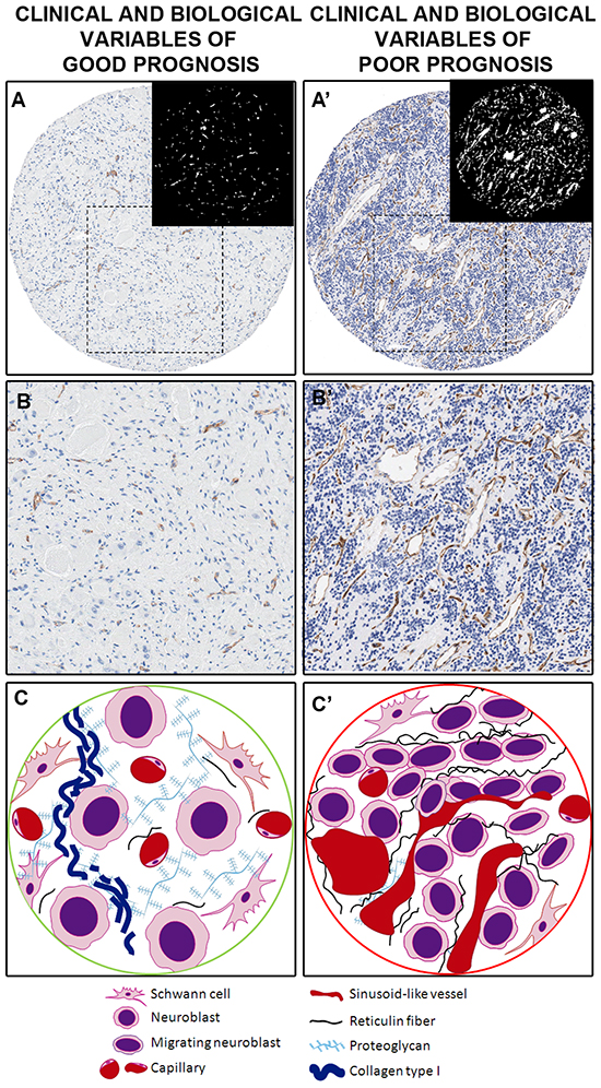 Examples and illustration of the vascular patterns in a neuroblastic tumor with favorable prognostic factors (A&#x2013;C) and with unfavorable prognostic factors (A&#x2019;&#x2013;C&#x2019;), illustrated by a GN and a pdNB, respectively.