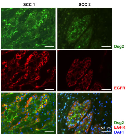 Co-localization of Dsg2 and EGFR in squamous cell carcinomas.