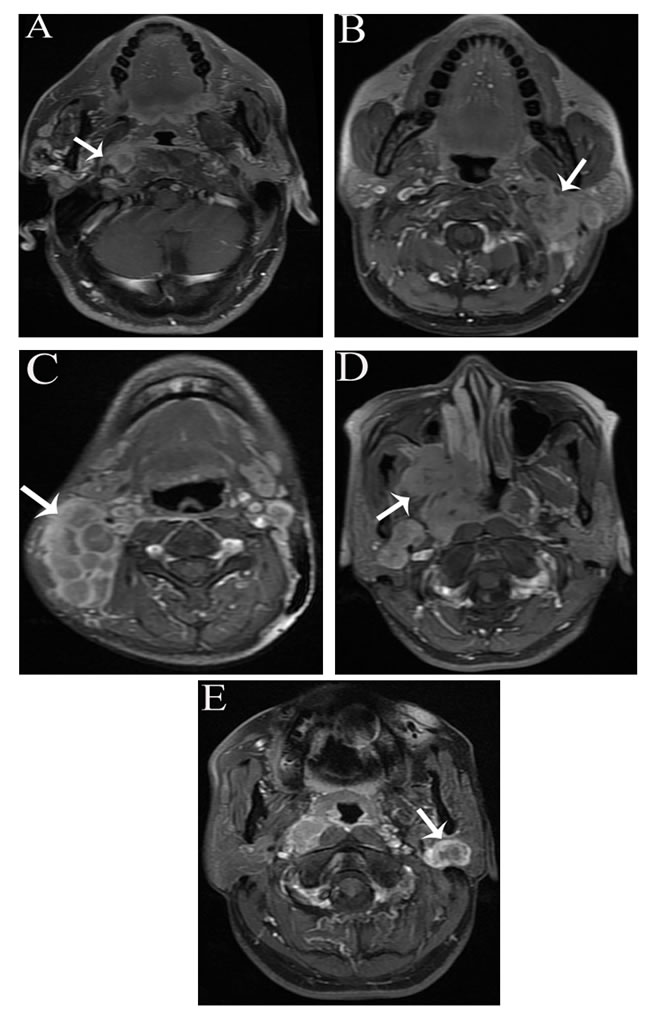 The characteristics of PLN spread on axial contrast-enhanced T1 fast spin-echo fat-suppressed (FSE fs) MRI.