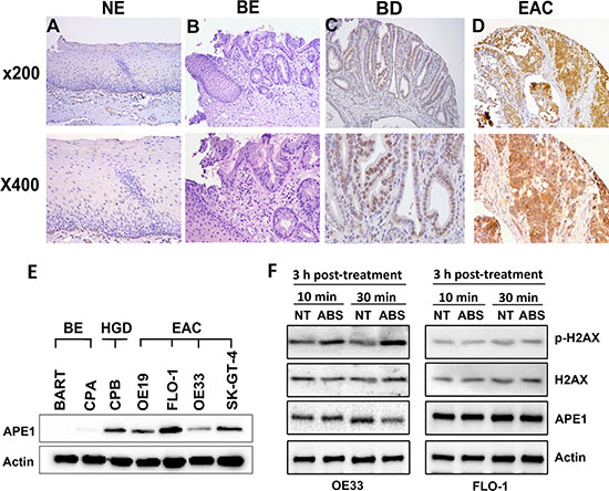 APE1 is overexpressed in esophageal adenocarcinomas and associated with decreased acidic bile salts-induced DNA damage.