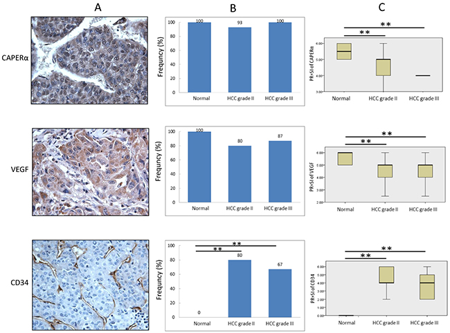 Comparison of expression of CAPER&#x03B1;, VEGF and CD34 in HCC and normal liver tissues.