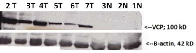 Western Blot validation of VCP proteins detected by proteomics in normal adjacent (N) and cervical precancerous and cancer tissues (T).