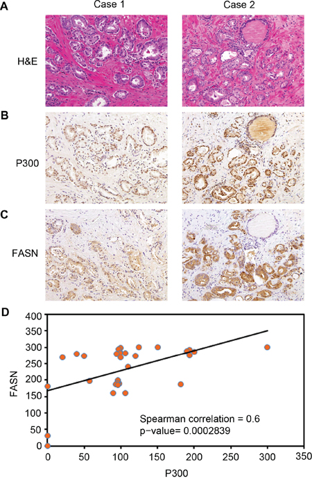 Expression of P300 positively correlates with FASN protein levels in human PCa specimens.