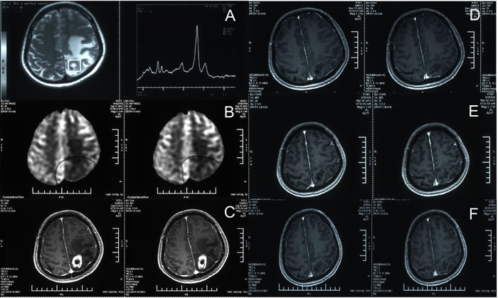 Management of brain necrosis during bevacizumab treatment.