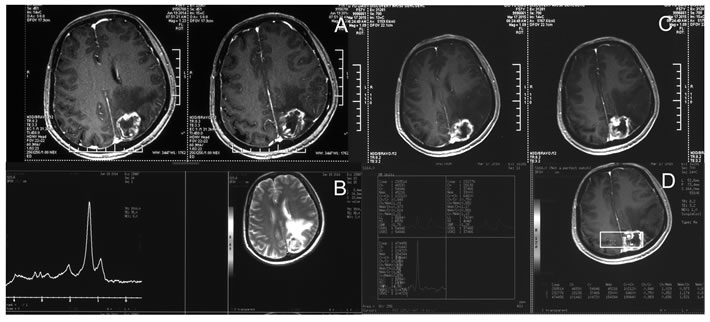 Brain necrosis progression and ineffective bevacizumab re-treatment.